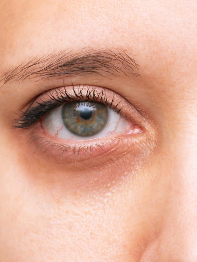 Ojeras Antes y despues Terssa mariana hernandez doctora