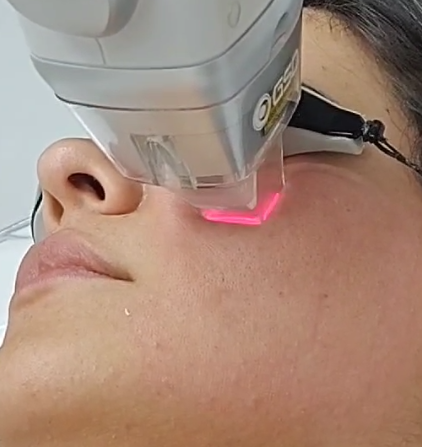 Láser Erbium Glass, Terssa estetica medica